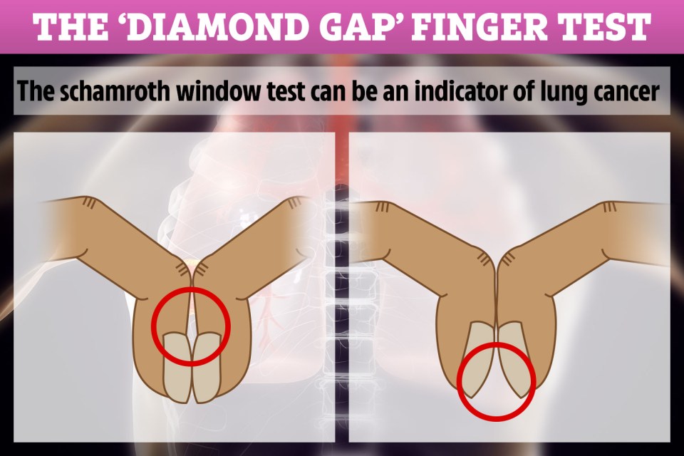 This simple test can be an indicator of lung cancer