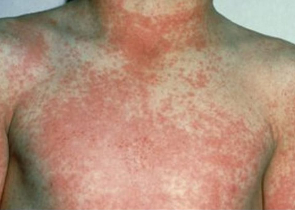  The rash might look a little like sunburn, and will start on the belly and chest before spreading to the limbs