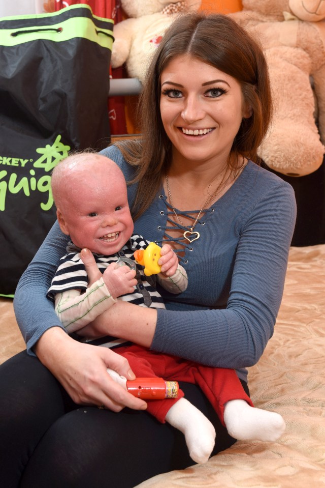  Michal Winter, with mum Anna, was born with rare skin condition Harlequin ichthyosis - that causes his skin to shed much faster than it should