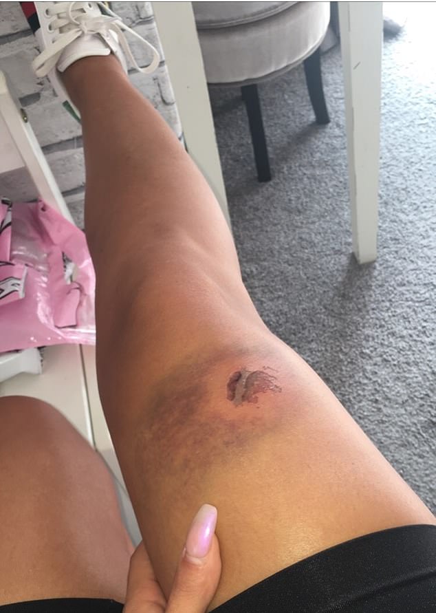  Gabriella Marabet was left with a bite mark on her knee