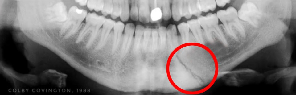 This is the X-Ray of Colby Covington’s jaw after he had it brutally broken