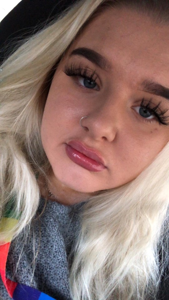  Now 22, Anna says she took the procedure because she'd been insecure about her lips 'forever'