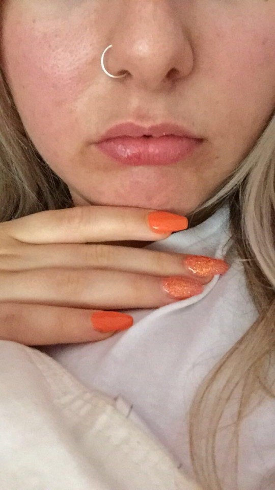  Anna's lips before she had any filler - she said she was influenced by celebs with large lips