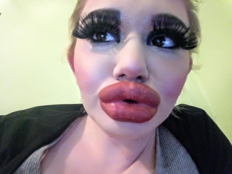  Andrea Ivanova has now had a total of 17 hyaluronic acid lip injections, quadrupling the size of her pout