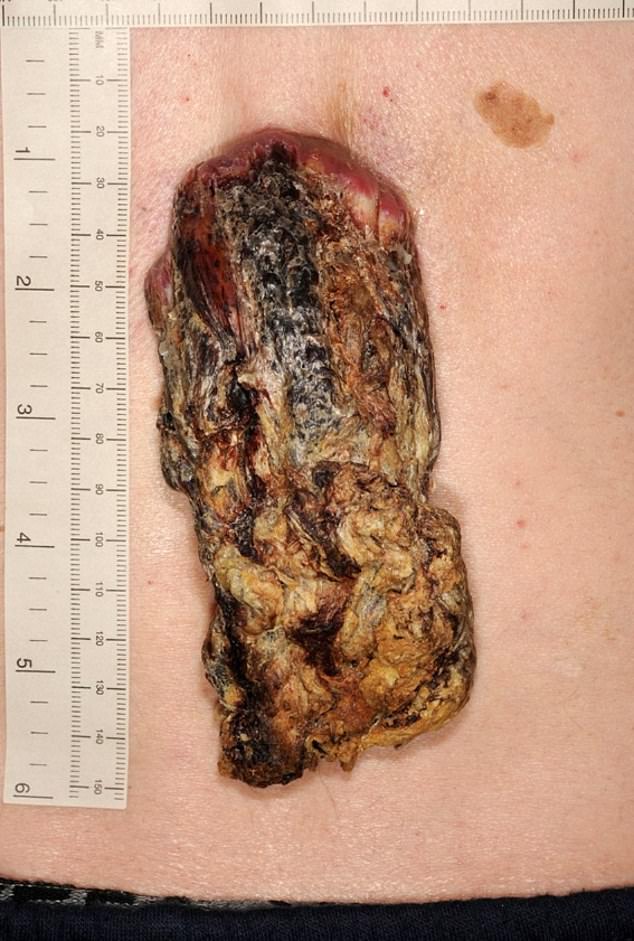  The 'dragon horn' was removed from the patient's back and the gaping hole was reconstructed with a skin graft from his thigh