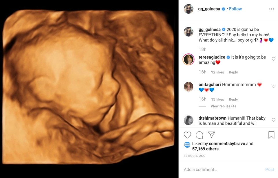 She posted a ultrasound photo showing a close up of the baby's face on Instagram