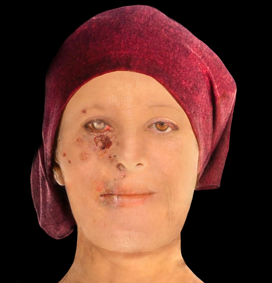  Forensic artists have reconstructed the face of a woman suffering from leprosy who died in Scotland around 500 years ago