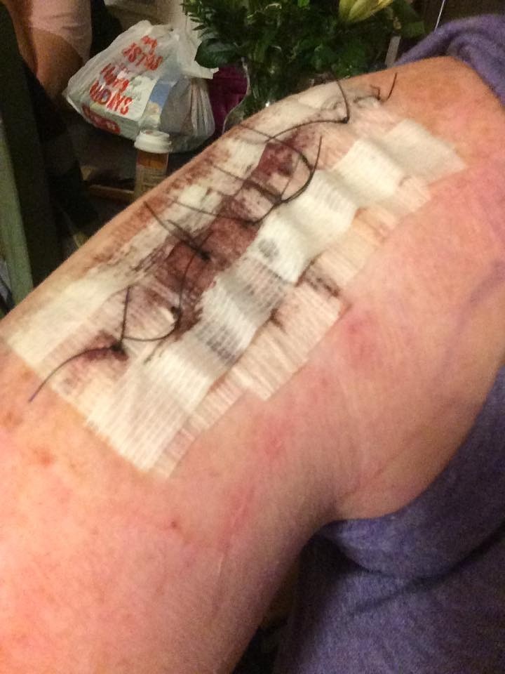 Jeska’s arm two days after her melanoma surgery