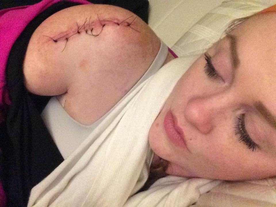 Jeska pictured showing the stitches on her shoulder after her melanoma surgery