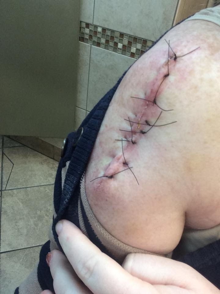 Jeska’s arm post-surgery with the stitches still in while she travelled around Texas while touring