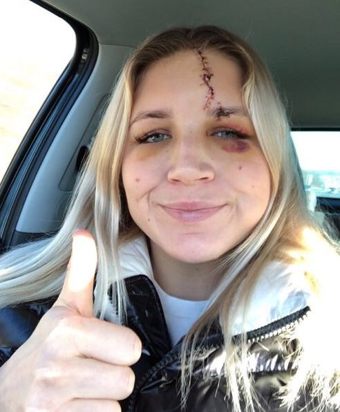  The keeper took to Instagram to show fans her injury