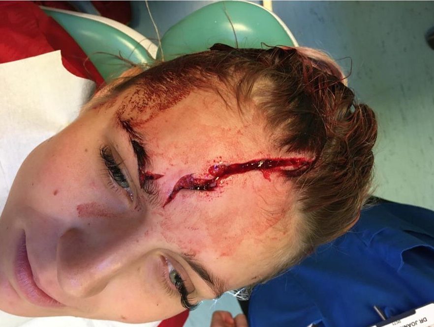  Liverpool Women's goalkeeper Fran Kitching sustained a gruesome head injury in a training ground incident