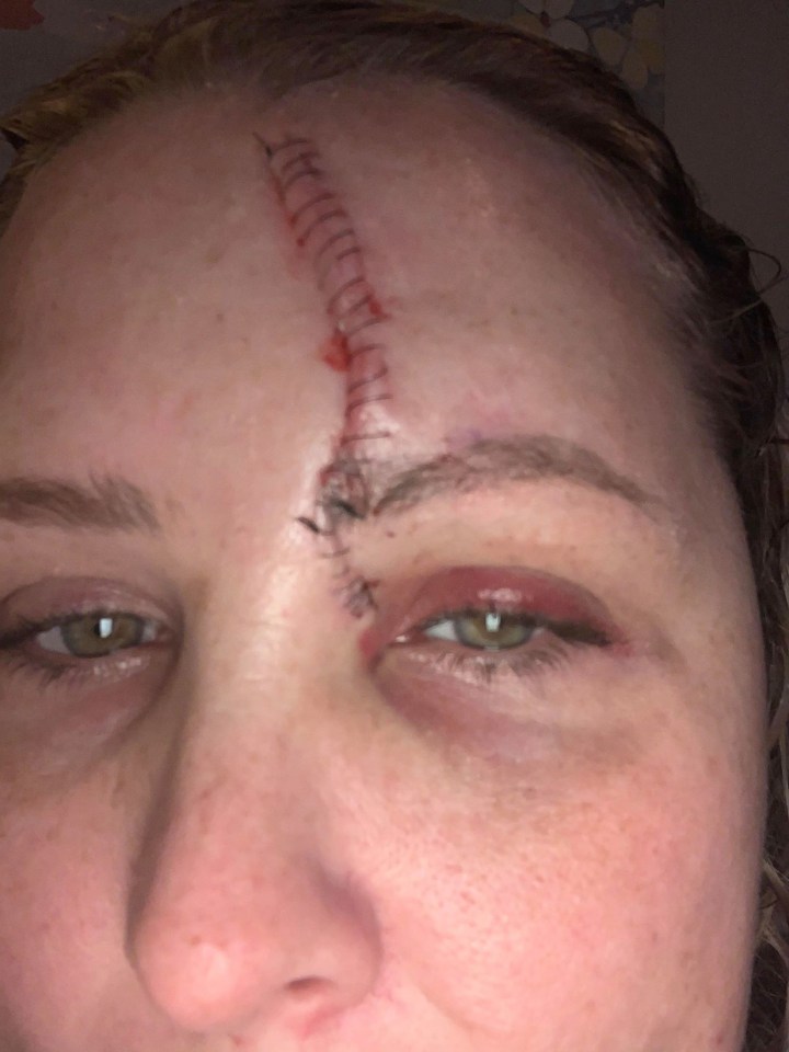 Carrie was devastated that the operation left her with a four-inch scar on her face