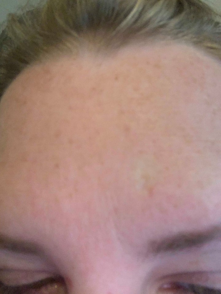 Carrie couldn’t get rid of a waxy looking spot on her forehead (pictured)