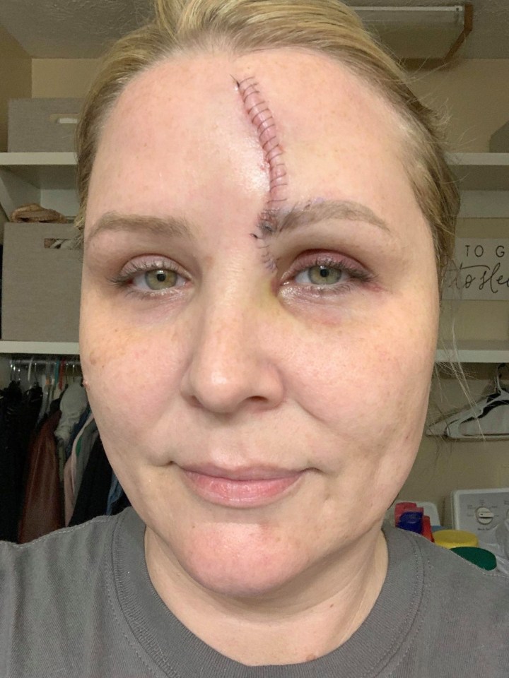 Carrie has been left with a four-inch scar on her face following surgery to clear her of the cancer