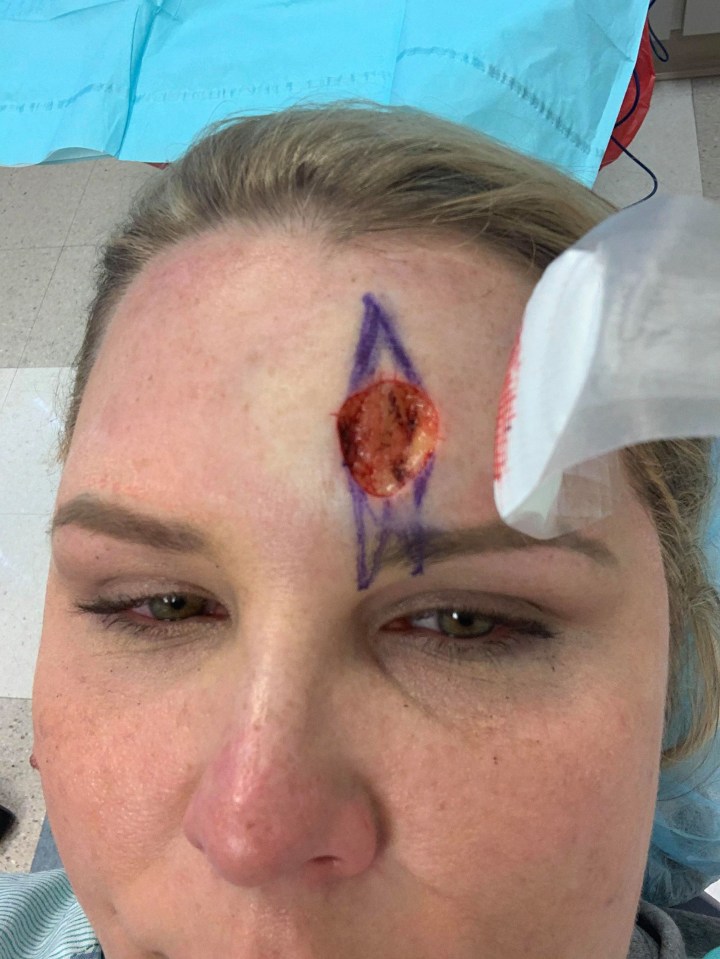 Carrie had six-hour long surgery to remove a 10p sized chunk of her forehead