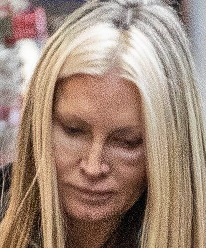  Caprice Bourret showed off a shiner on her eye