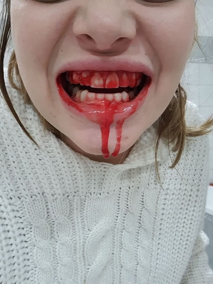  The mum has suffered bleeding gums, during her second pregnancy