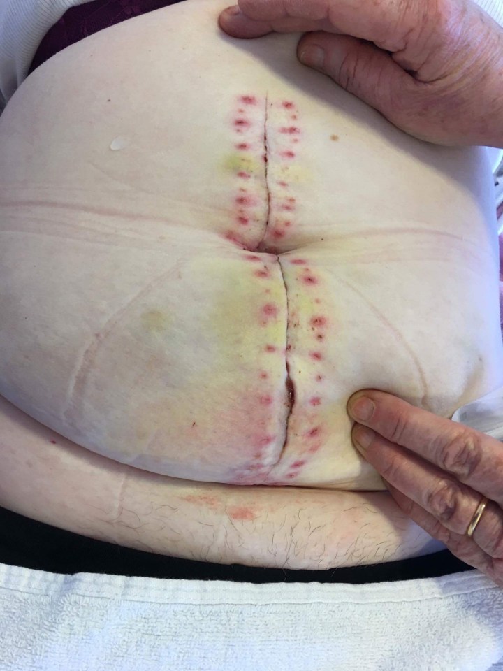  The 47-year-old needed life-saving surgery to remove an eight-pound cyst