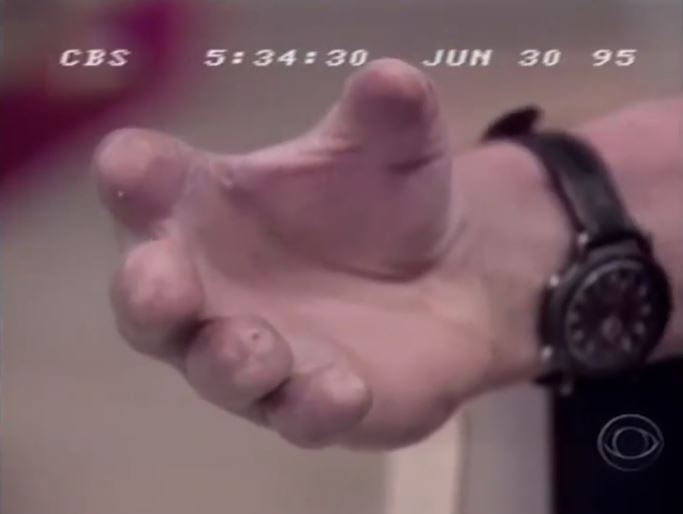  John Hauser revealed his stumps in the documentary, after having his fingers blown off in a pipe bomb