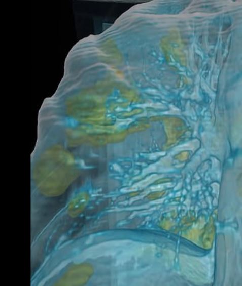  The green colour shows how the coronavirus patient's lungs are clouded with many areas of infection