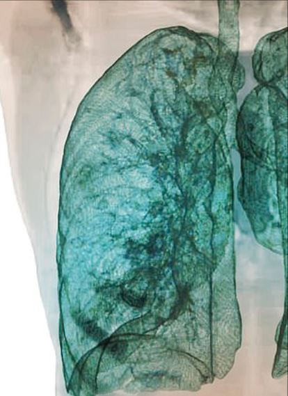  This scan shows how a healthy lung should look, with light blue colorisation showing healthy, clear tissue