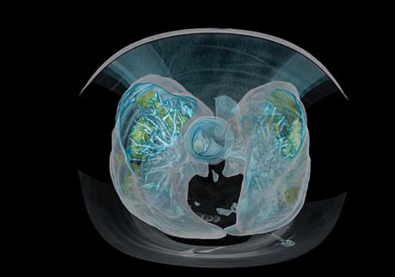  From above, the contrast between the green infected lung tissue and the healthy blue tissue is clear