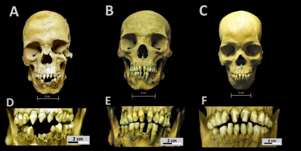  Skulls from three 16th century skeletons found in a mass grave in Mexico. The teeth from each skull had been modified before death, a practice common in some regions of Sub-Saharan Africa even today