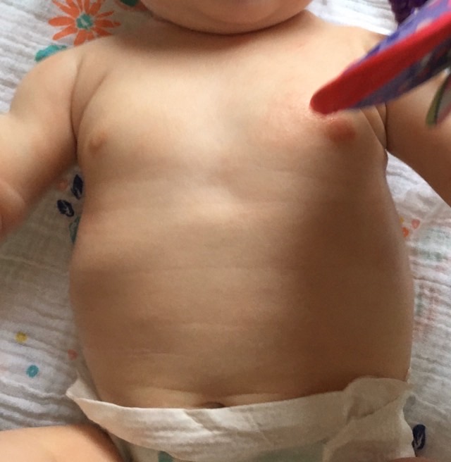  Florence's skin has now cleared up and she's able to crawl around without crying  