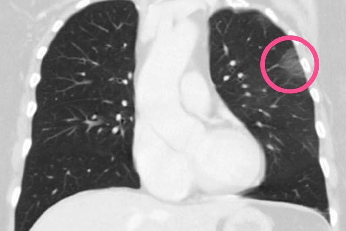  A CT scan shows Covid-19 pneumonia on the lungs of a Swedish woman who attended a routine scan as part of a follow-up to cancer treatment