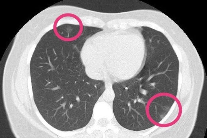  A chest scan found coronavirus pneumonia in the lungs of a healthy 30-year-old woman with no symptoms of the disease