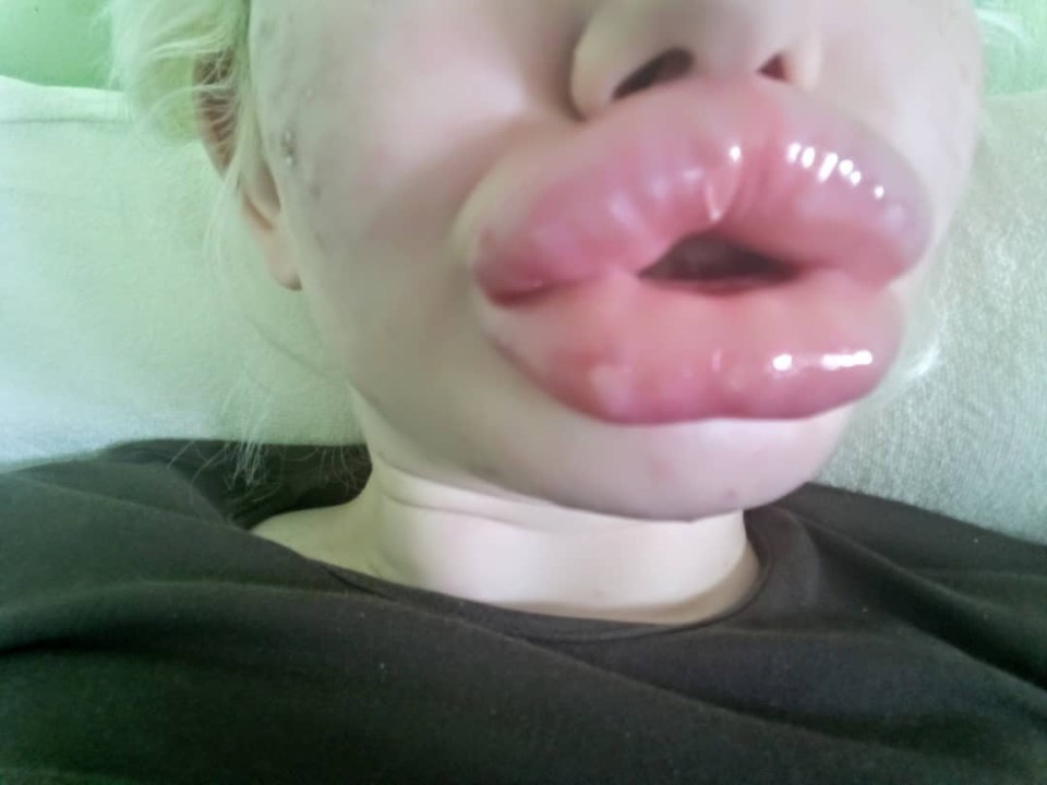 She posted this picture of her 20th lip injection on Tuesday