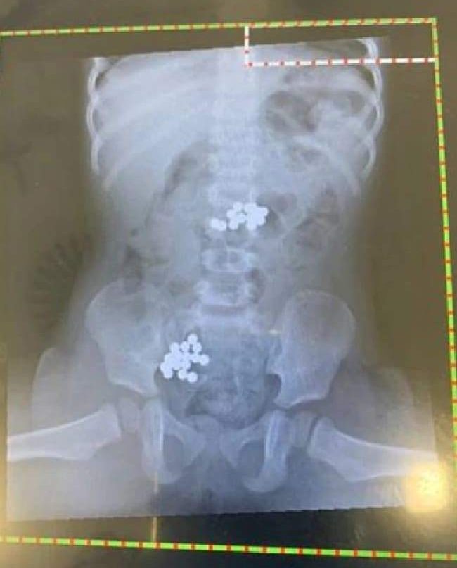  The X-ray showing the ball bearing-style magnets lodged in the toddler's tummy and bowel