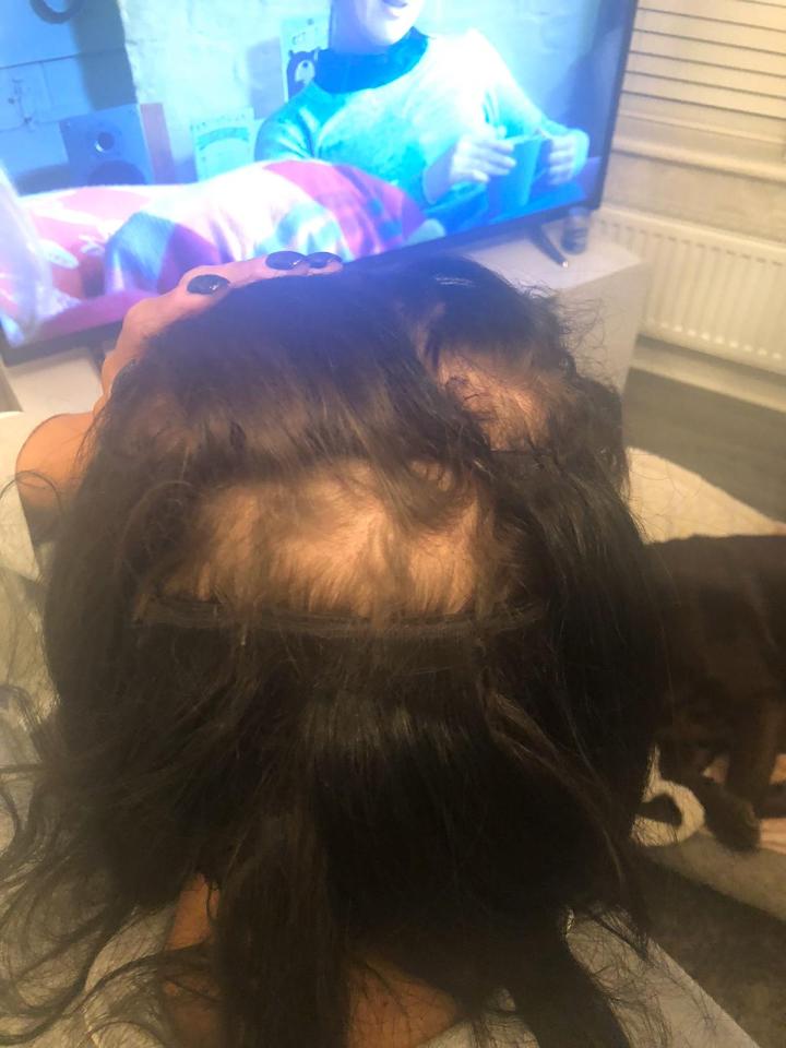  Clumps of hair started falling out of her head