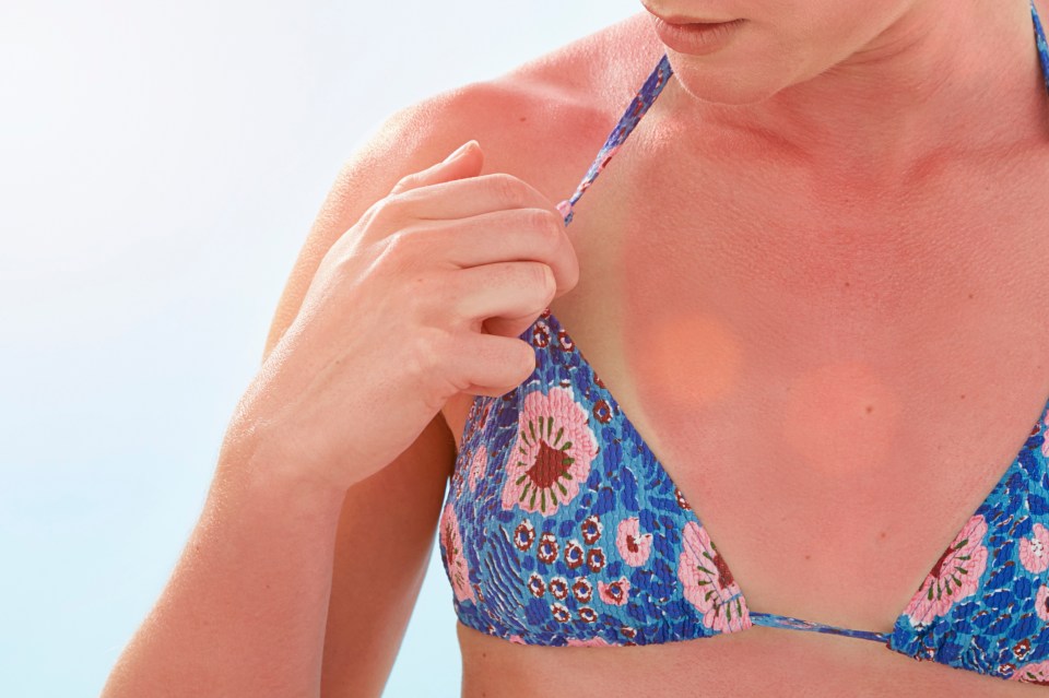  Medics are now warning of a rare sunburn reaction known as hell’s itch