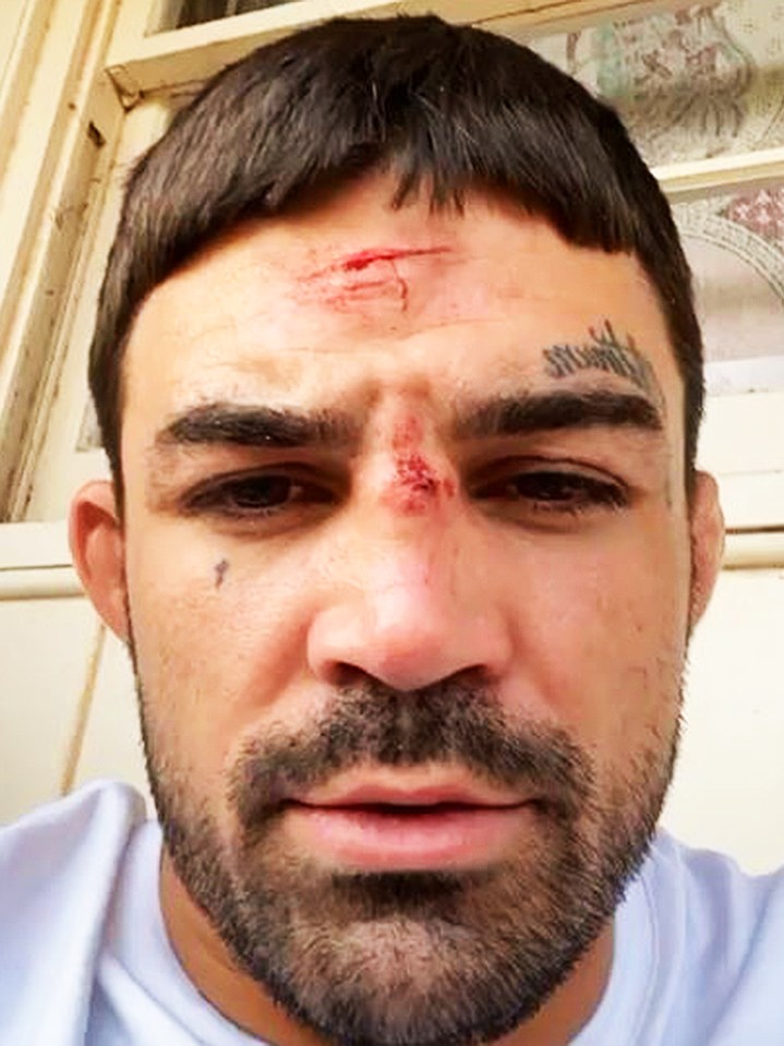  Mike Perry showed off some gruesome mystery cuts on his head and hands just a week before he fights Mickey Gall in Las Vegas