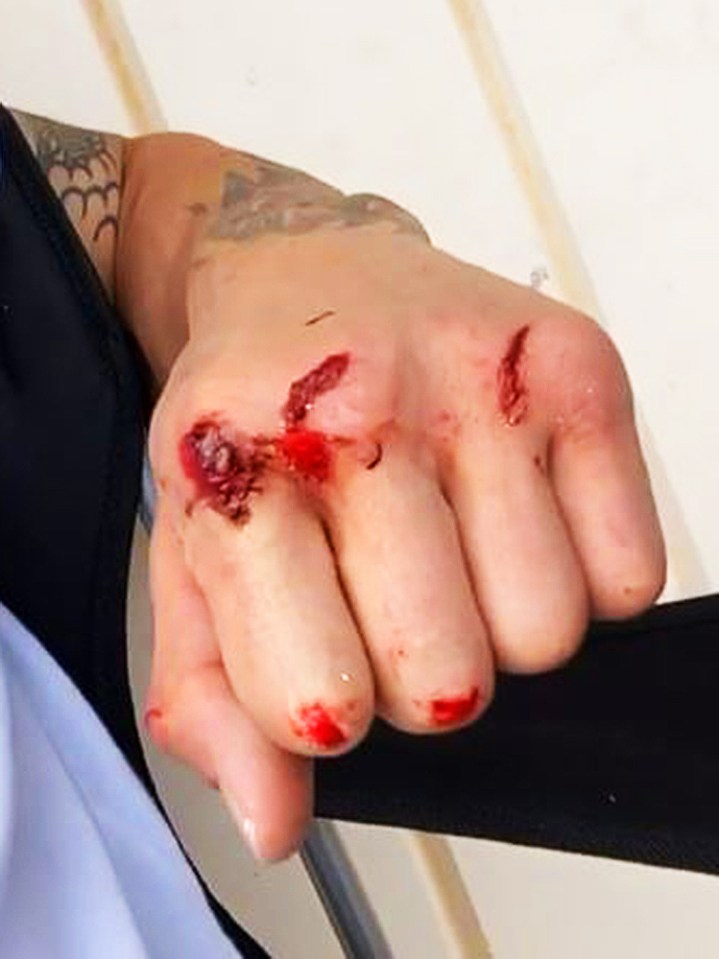  Perry took to Instagram to reveal cuts across his fists and forehead but did not clarify where they came from