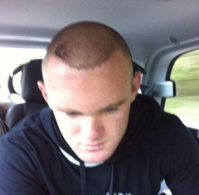  Just after his first hair transplant in 2011