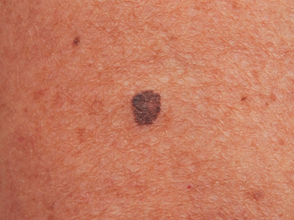 A malignant superficial spreading melanoma on the thigh