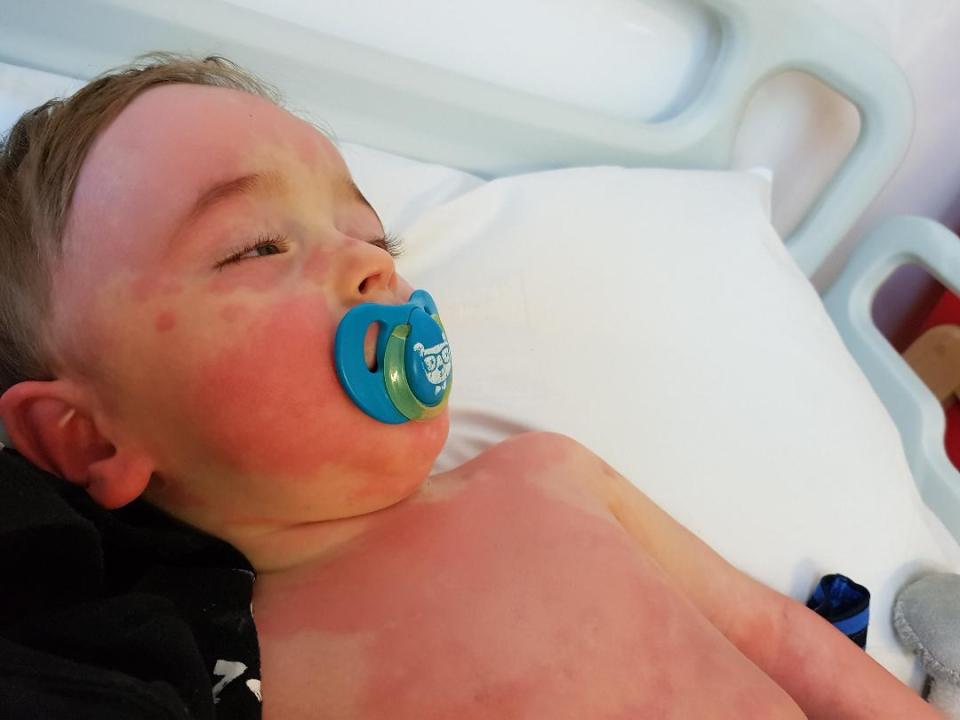 Two-year-old Bertie was taken straight to hospital after waking with a rash on his tummy and chest