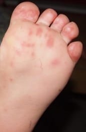 The rash on Kayden's feet was red and cracked