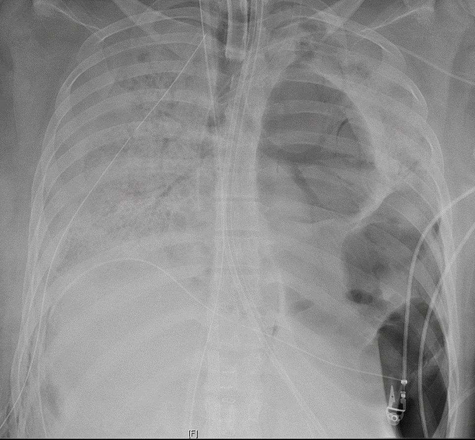 An X-ray of the woman's chest before she had a double lung transplant