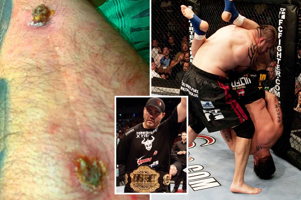  Former UFC champ Tim Sylvia and his arm that was famously broken in 2004. Left, the injury has become horribly infected now