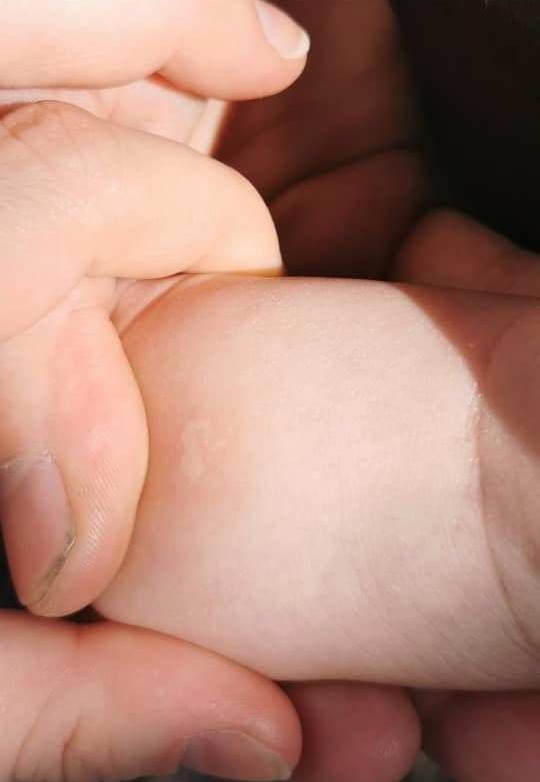 The mum claims it gave her baby a small blister