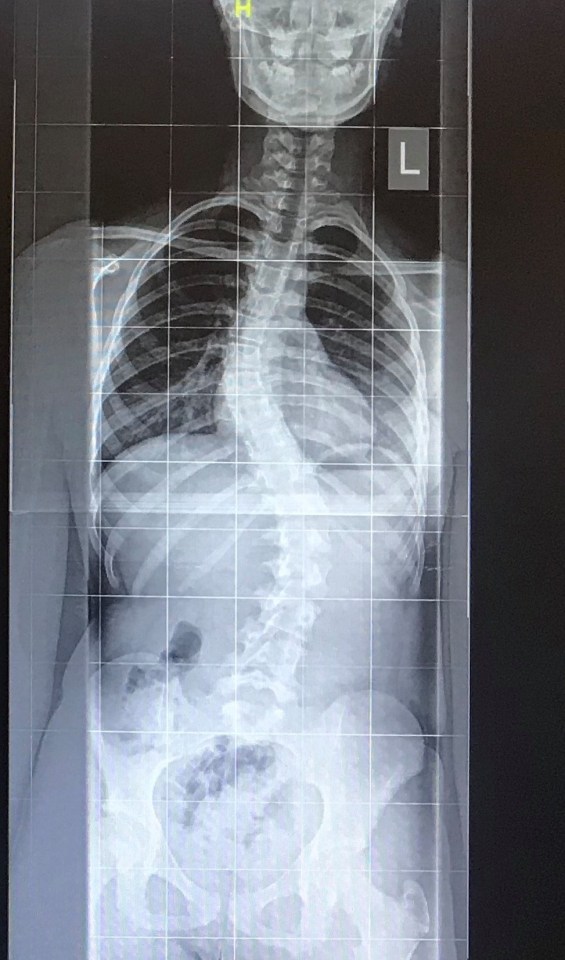 At 14, the curving of Megan's spine got so bad that she had to have surgery