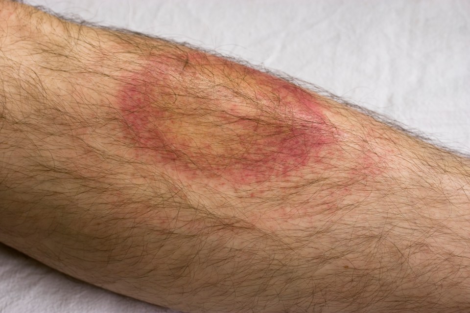 Image above shows Lyme Disease caused by a tick bite