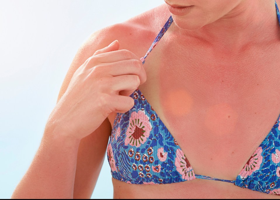 Many skin cancers develop as a result of too much sun exposure