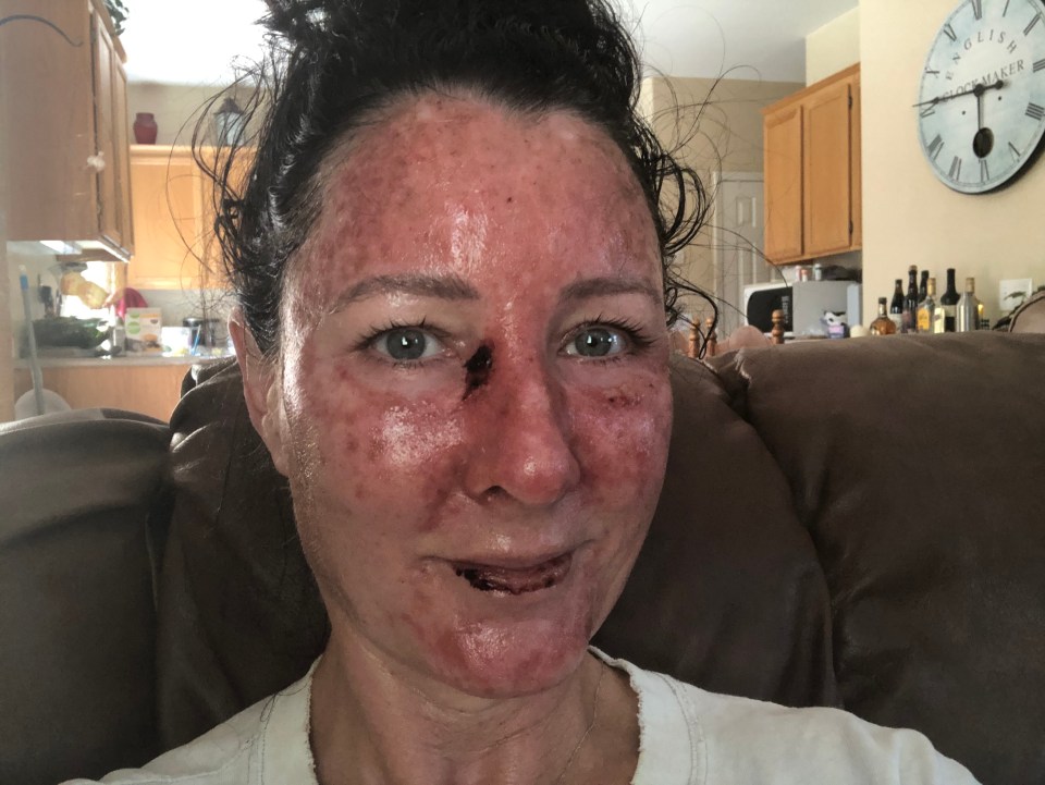 In June she was diagnosed with non-melanoma basal cell carcinoma