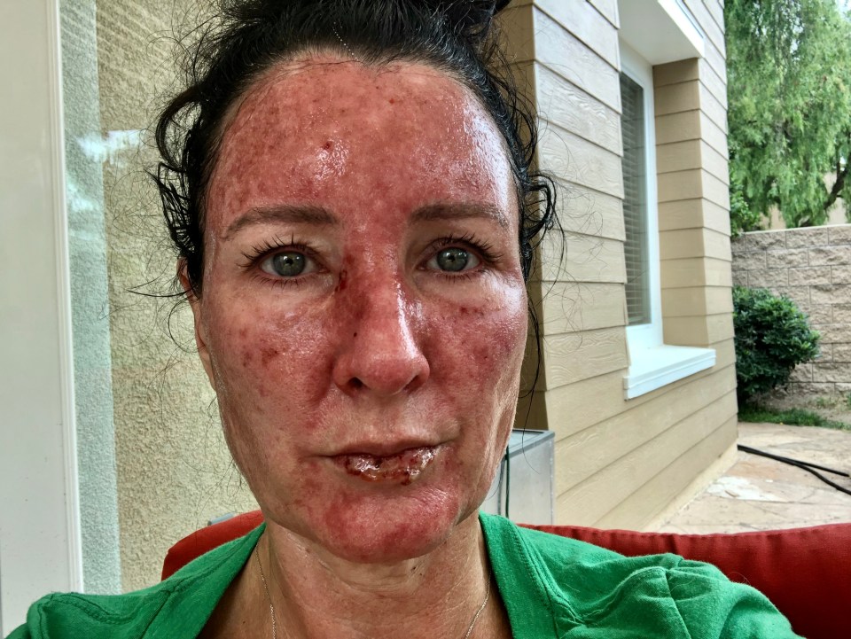 'Real-life mermaid' Stephanie Huff was left with skin cancer and face scabs after refusing to wear suncream 