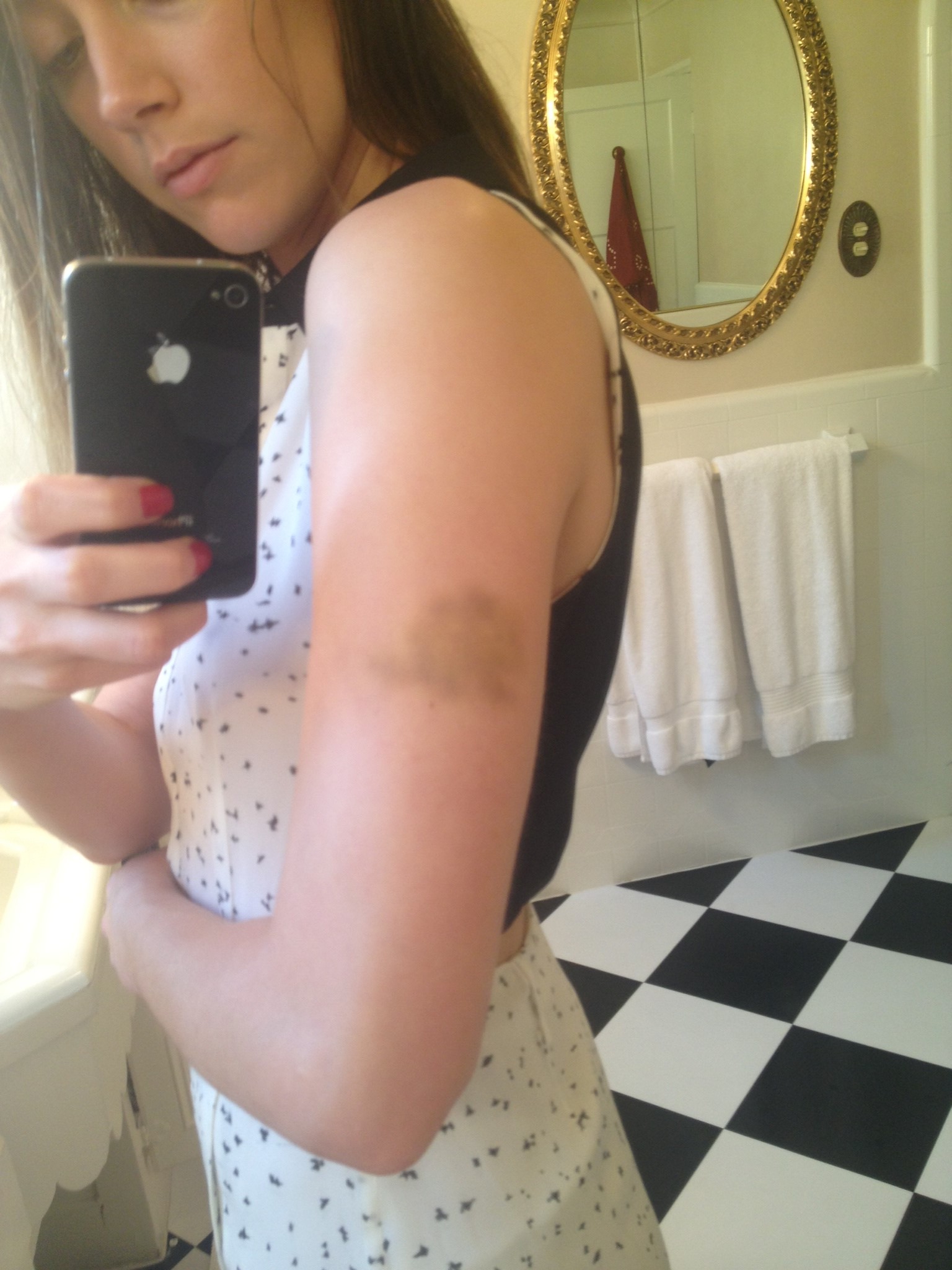 A picture of Amber's bruised arm shown to the court today